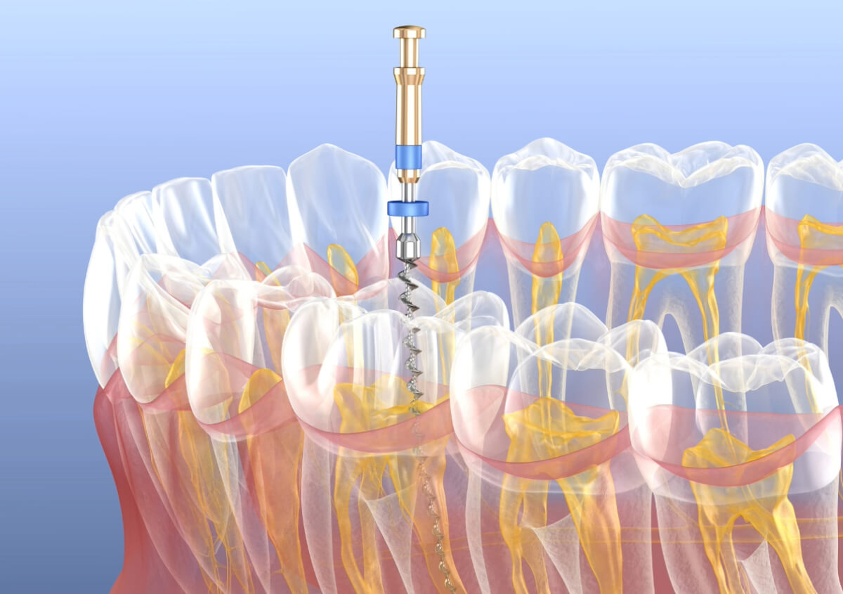 Root Canal Retreatment in Conyers GA area